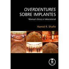 Overdentures Sobre Implantes